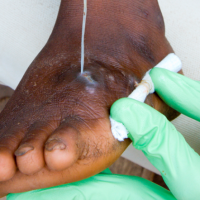 Guinea Worm Disease Edges Closer to Extinction: